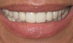 After Veneers
