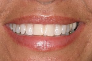 Before Veneers