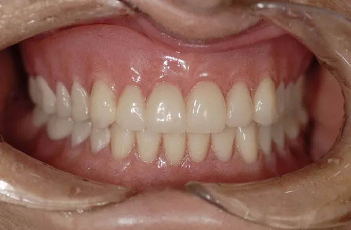 After Dentures