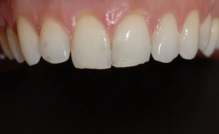 Before Esthetic Recontour