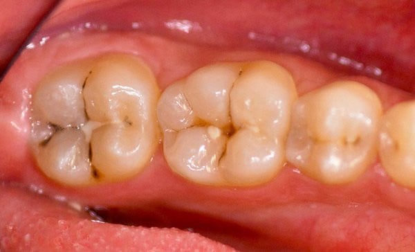 Before Fillings