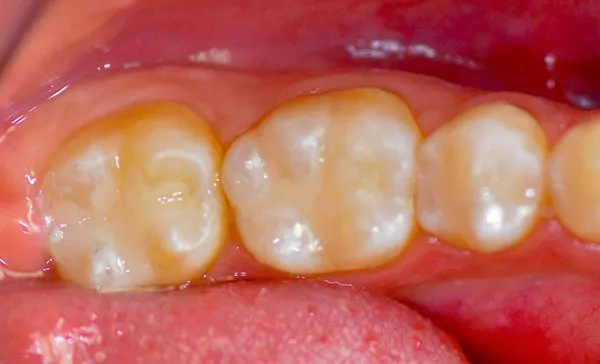 After Fillings