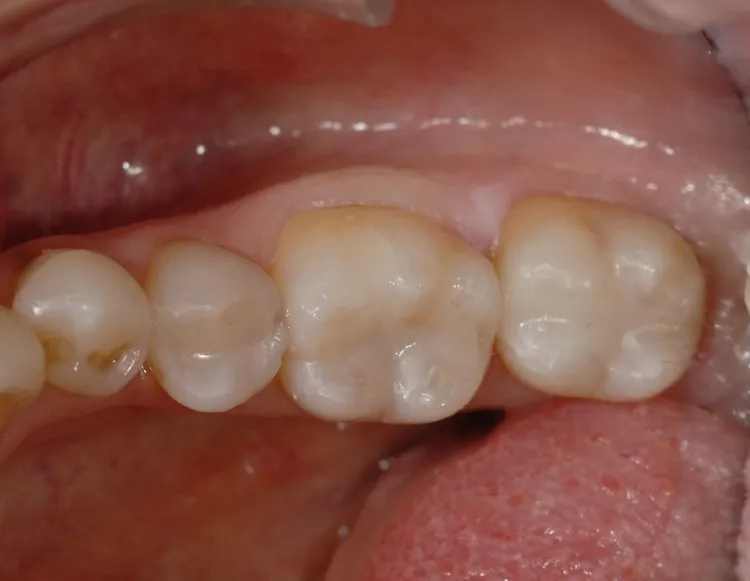 After Posterior Composite