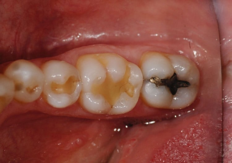 Before Posterior Composite