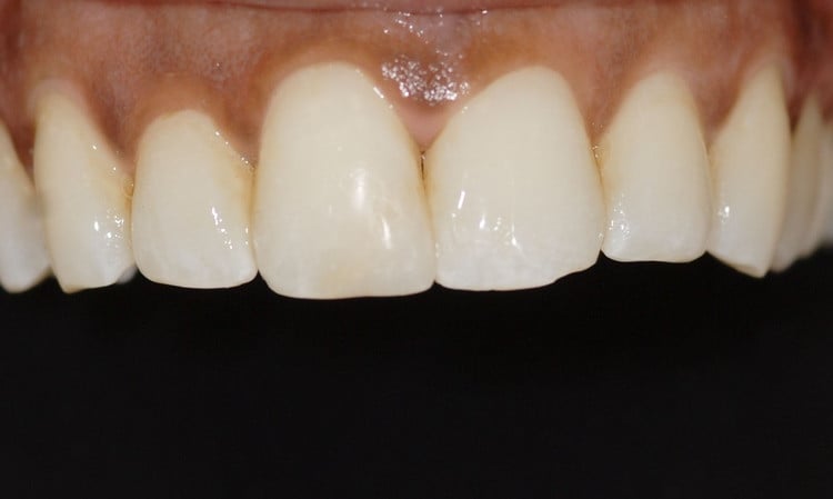 After Redo Stained Bonding Esthetic Recontour