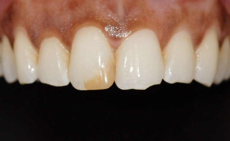 Before Redo Stained Bonding Esthetic Recontour