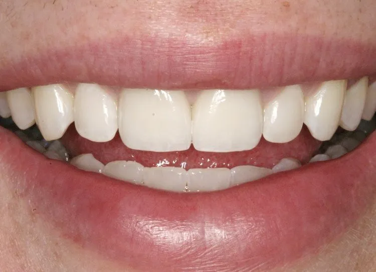 After Whitening and Veneers