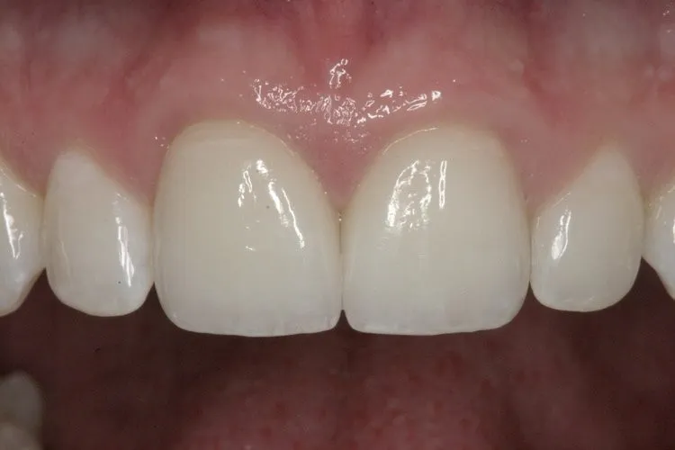 After Whitening and Veneers