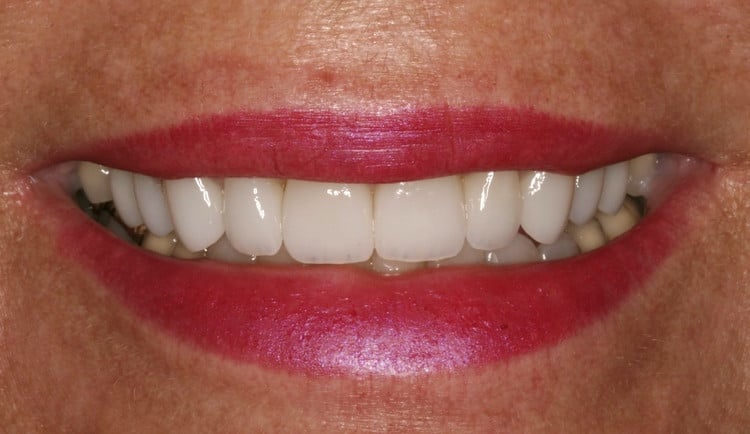 After Porcelain Veneers