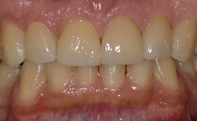 After Porcelain Veneers