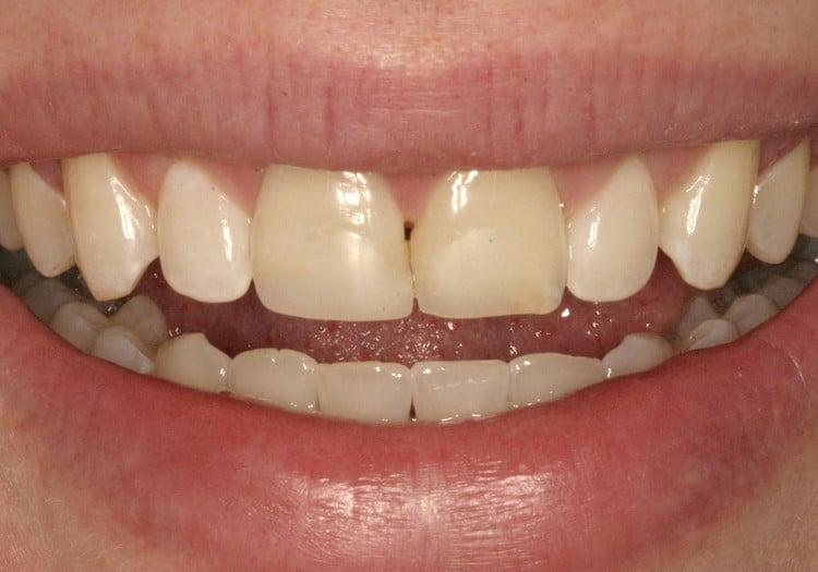 Before Whitening and Veneers