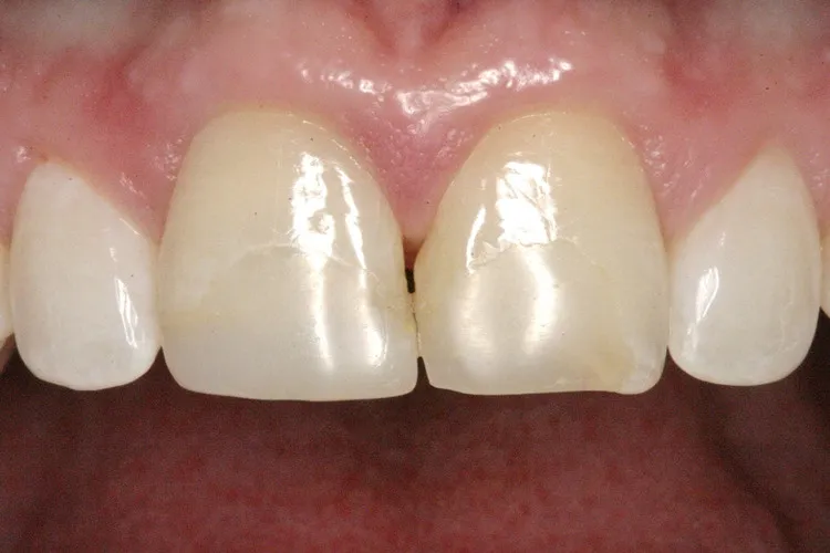 Before Whitening and Veneers