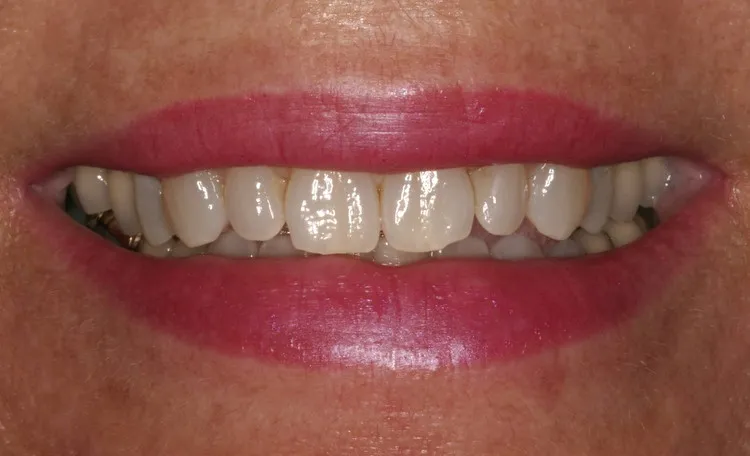 Before Porcelain Veneers