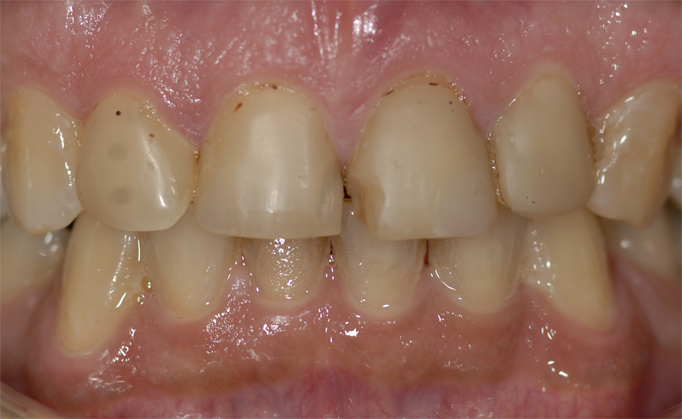 Before Porcelain Veneers